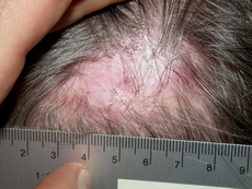 Haarerkrankung - Dr. Mario Graf - Praxis für Dermatologie, Hautarzt in Zürich